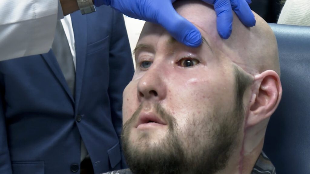 The first face transplant to include an eye shows no rejection a year later 090624 Ac Eye Transplant Feat.jpg