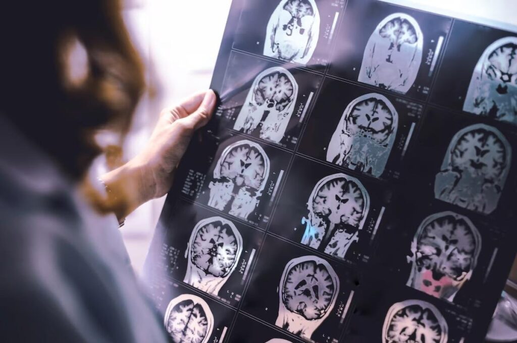 Diabetes can age brain, but lifestyle changes may reverse it Diabetes can age brain but lifestyle changes may reverse it.jpg