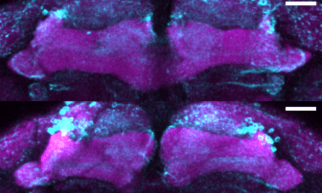New mutation linked to early-onset Parkinsonism New20mutation20linked20to20early Onset20parkinsonism2028229.png