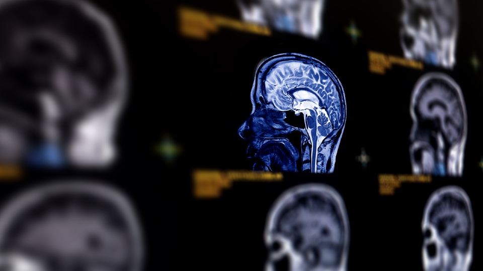 Why identifying lifestyle changes and treatments that reduce dementia risk is complicated | Media Centre Brain Scan Image.jpg
