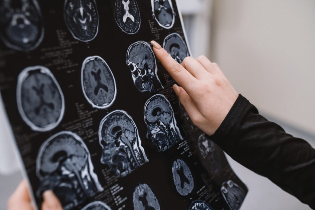 Stroke remains a leading cause of death globally, with increased risk linked to lifestyle factors Imagefornews 792240 1728032134203273.jpg
