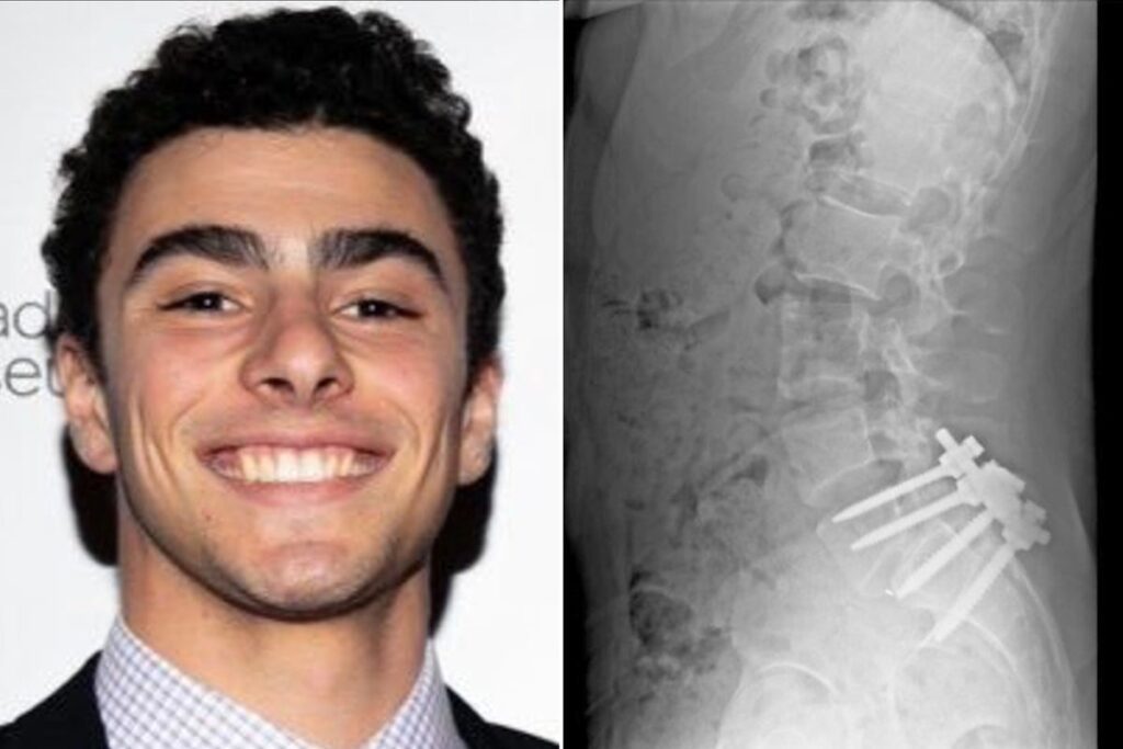 Luigi Mangione ‘went missing’ after back surgery and struggled with health issues, friends reveal 54bb96298585b34c1f6eed862b64d8c1.jpeg