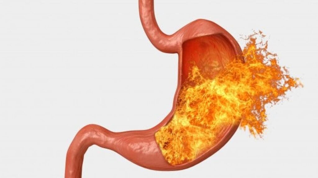 Diet, lifestyle hacks to say goodbye to acid reflux and protect yourself from oesophageal cancer | Health Acid Reflux 1739358617607 1739358617789.jpg