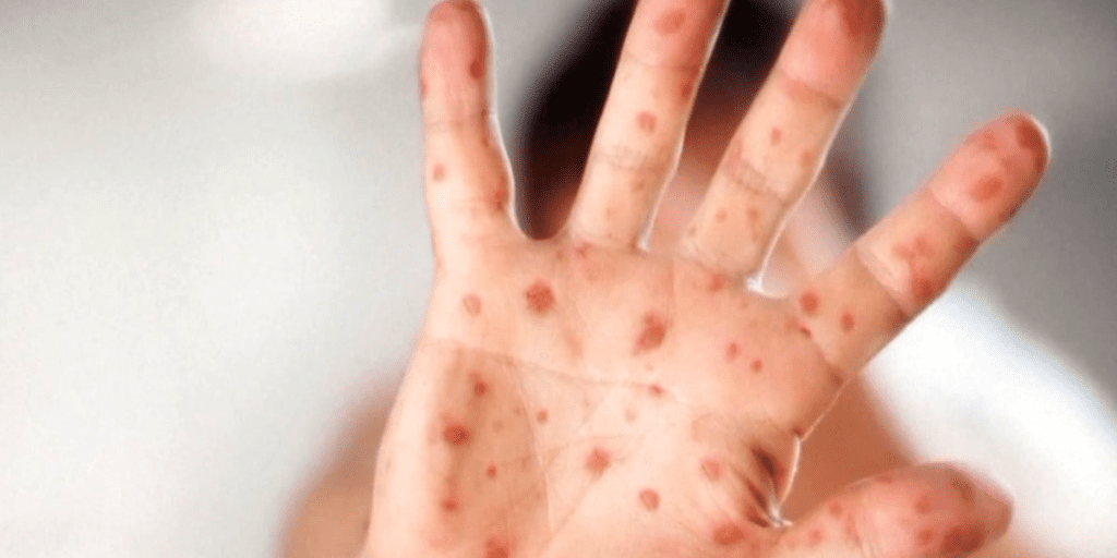 NYS Dept. of Health issues travel advisory due to rising measles cases 6wxrgxkncfe7royrmguq62jgty.png