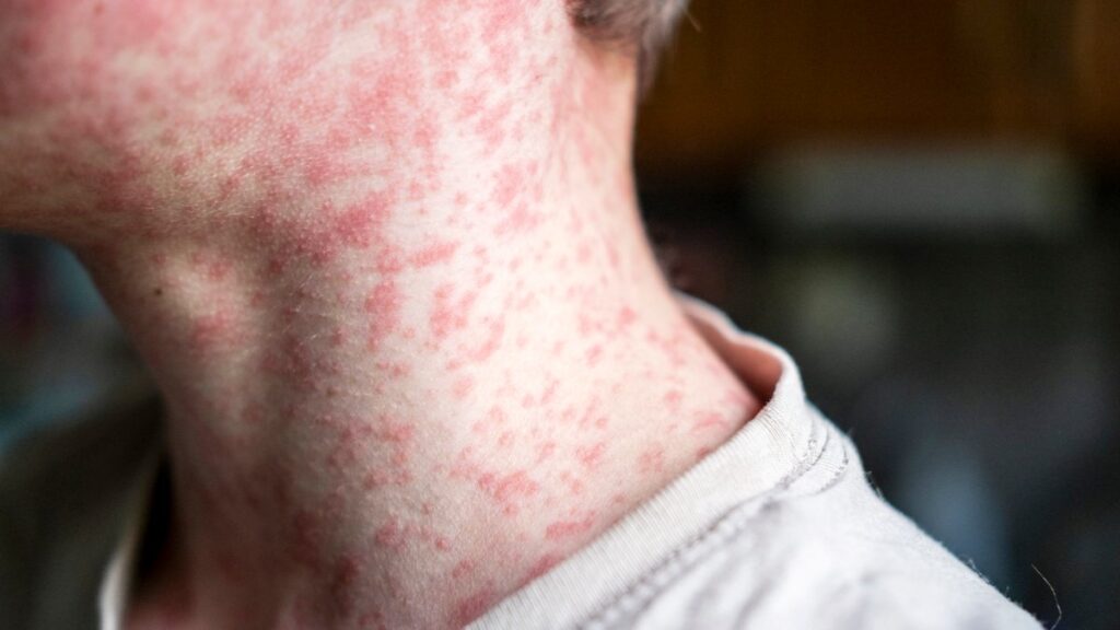 TCPH issues measles ‘exposure notice’ for two Grapevine venues – NBC 5 Dallas-Fort Worth Gettyimages 2152300024.jpg