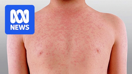 NSW Health issues measles alert for Sydney’s eastern suburbs A413e91c1e7172c20b49c0cfc119f820.jpeg