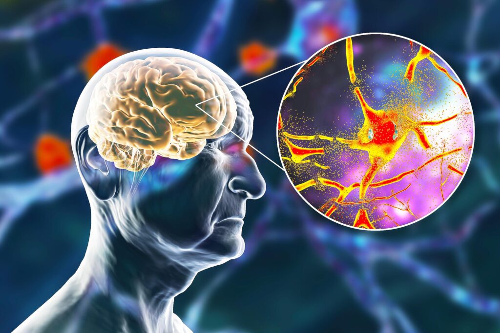 Cognitive decline alzheimers top lifestyle factor 1m.jpg