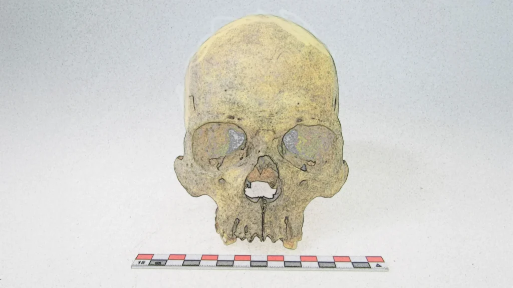 Ancient DNA reveals leprosy hit the Americas long before colonization Human skull mycobacterium lepromatosis.webp.webp