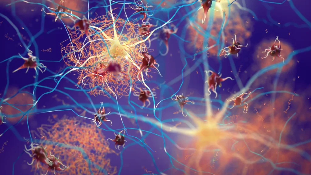 Scientists melt early protein clumps and shut down Alzheimer’s damage Amyloid plaques forming between brain neurons.webp.webp