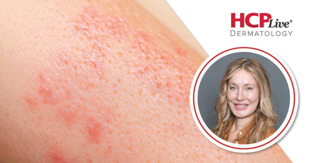 Tips on Advising Dermatology Patients on Diet and Lifestyle Choices, With Heather Goff, MD, MPH C21a985b4e998199e8e4672c448aaecff9e5a895 1200x628.png