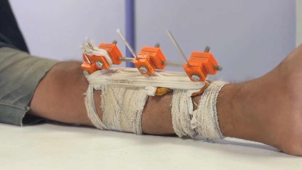 Gaza doctors use 3D tech to save limbs shattered by Israel from amputation | Israel-Palestine conflict News Image 1766055371.jpg